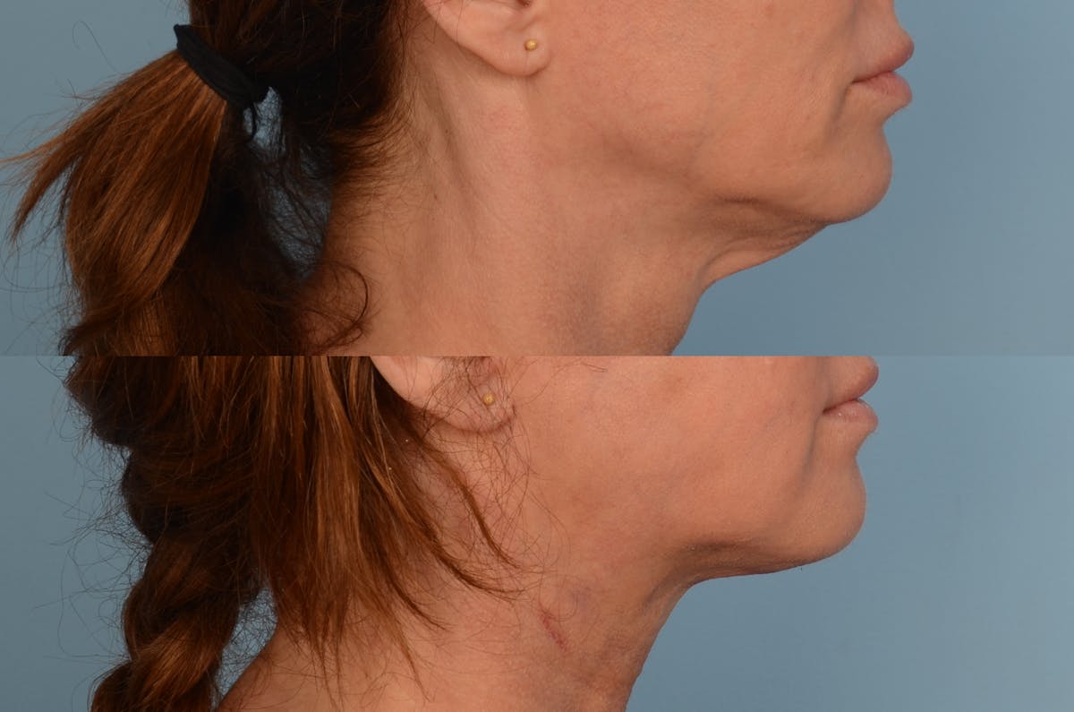 Thread Lift Before & After Gallery - Patient 48369801 - Image 2