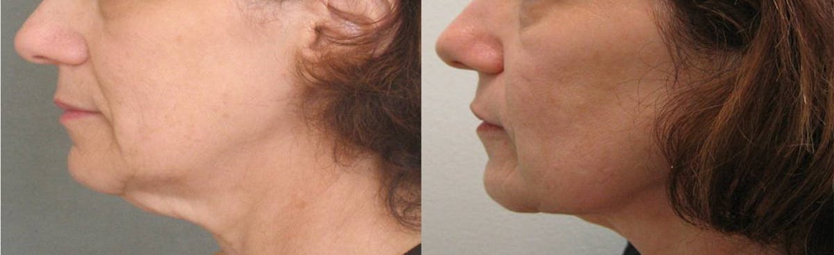 Thread Lift Before & After Gallery - Patient 48369802 - Image 1