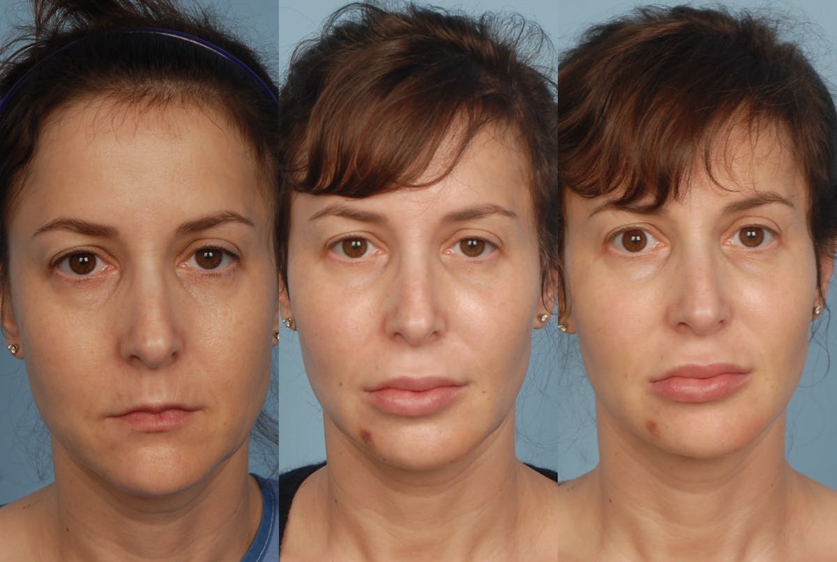 Fat Injections Before & After Gallery - Patient 48369855 - Image 1