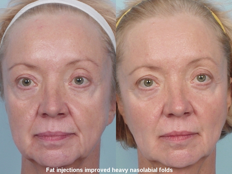 Fat Injections Before & After Photos Grossman Dermatology