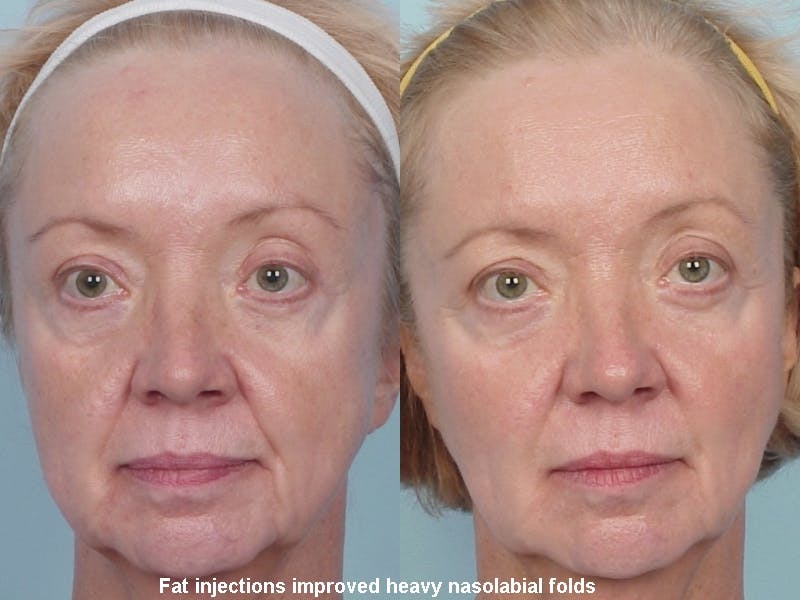 Fat Injections Before & After Gallery - Patient 48369856 - Image 1