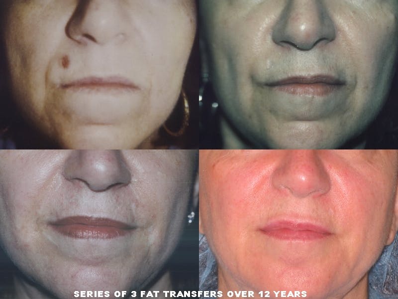 Fat Injections Before & After Gallery - Patient 48369857 - Image 1