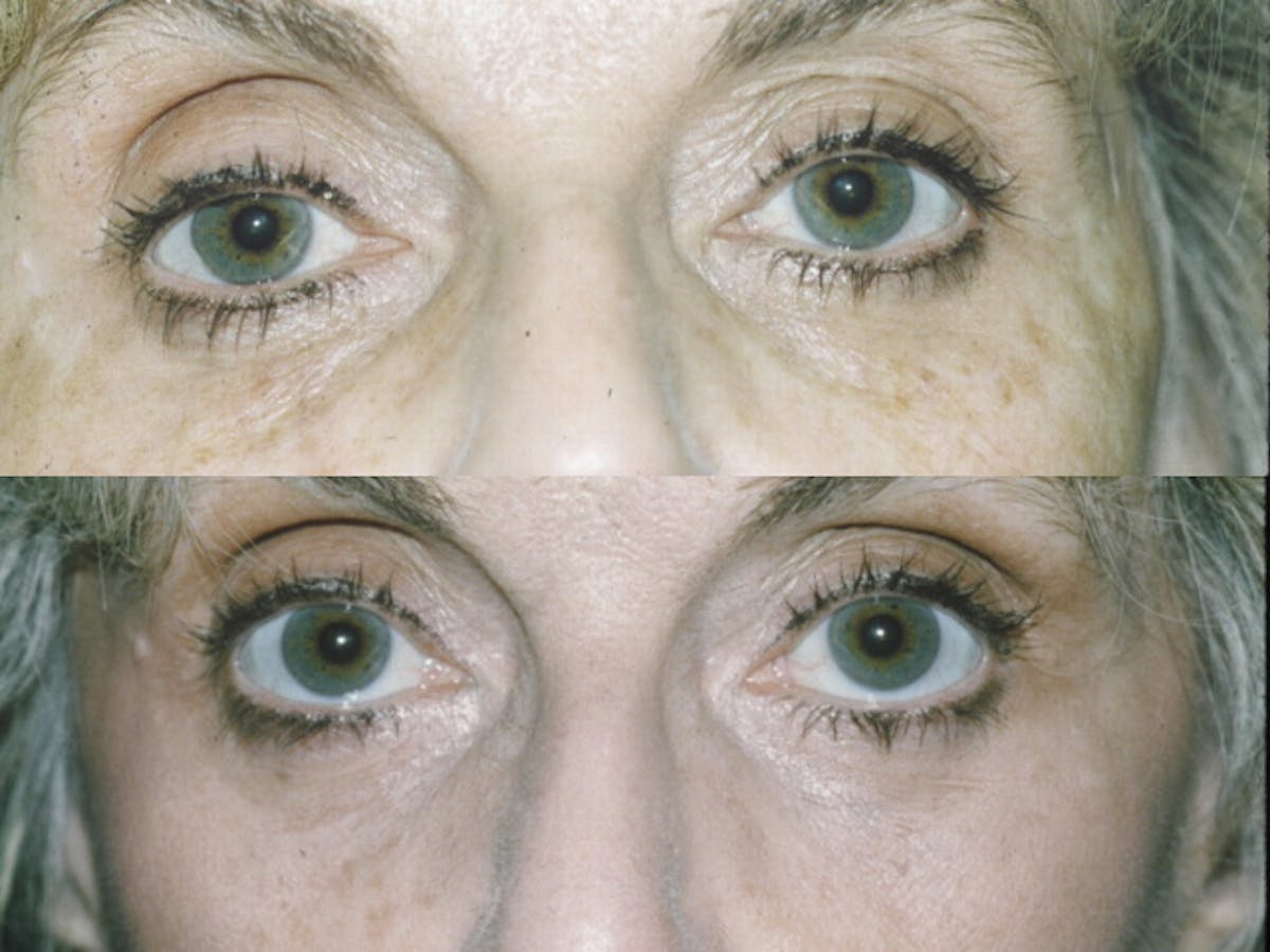 Fat Injections Before & After Gallery - Patient 48369859 - Image 1