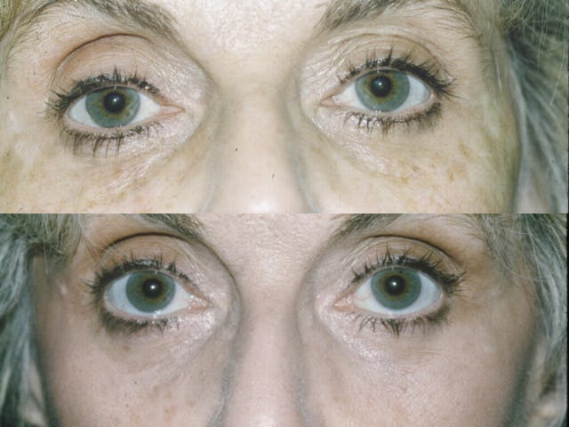 Fat Injections Before & After Gallery - Patient 48369859 - Image 1