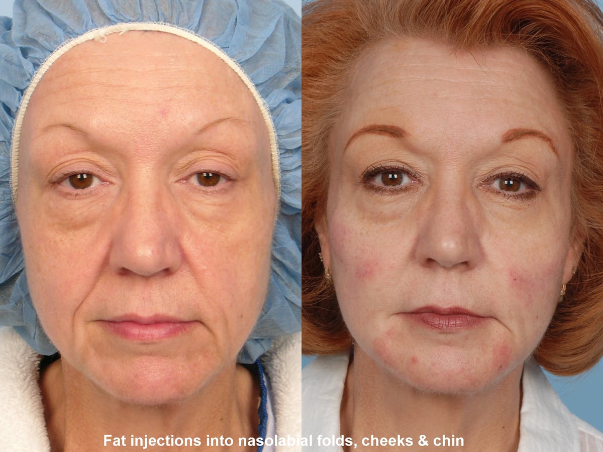 Fat Injections Before & After Gallery - Patient 48369860 - Image 1