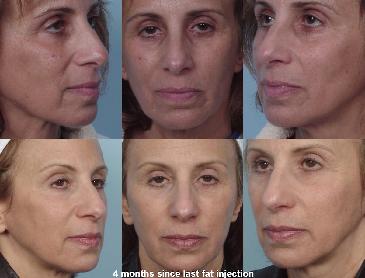 Fat Injections Before & After Gallery - Patient 48369861 - Image 1