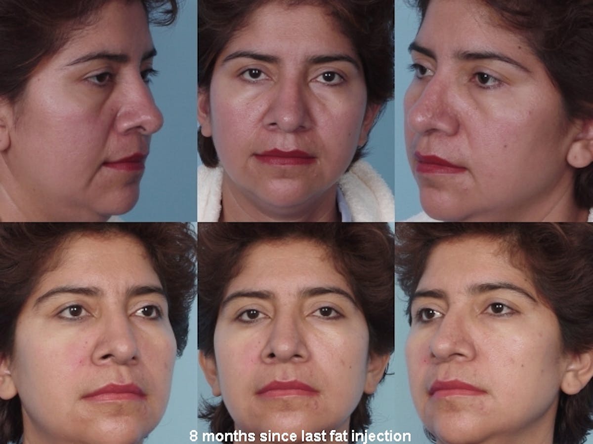 Fat Injections Before & After Gallery - Patient 48369862 - Image 1