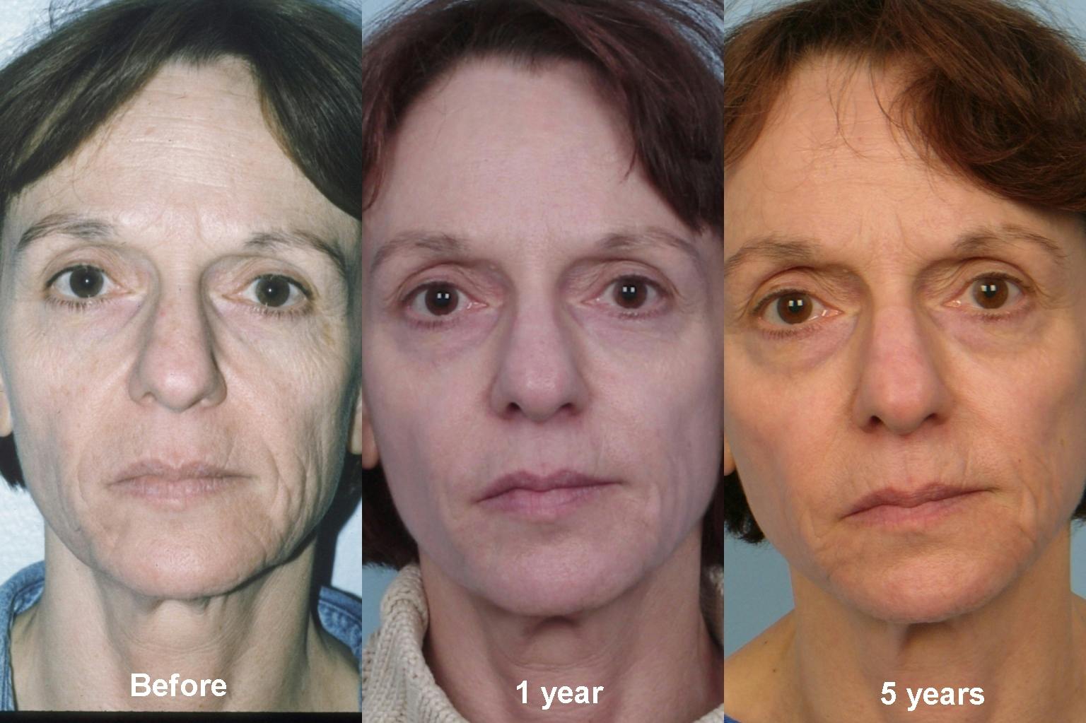 Fat Injections Before & After Gallery - Patient 48369863 - Image 1