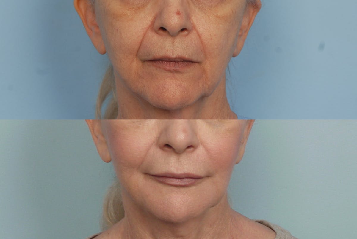 Lower Face Before & After Gallery - Patient 227069 - Image 1