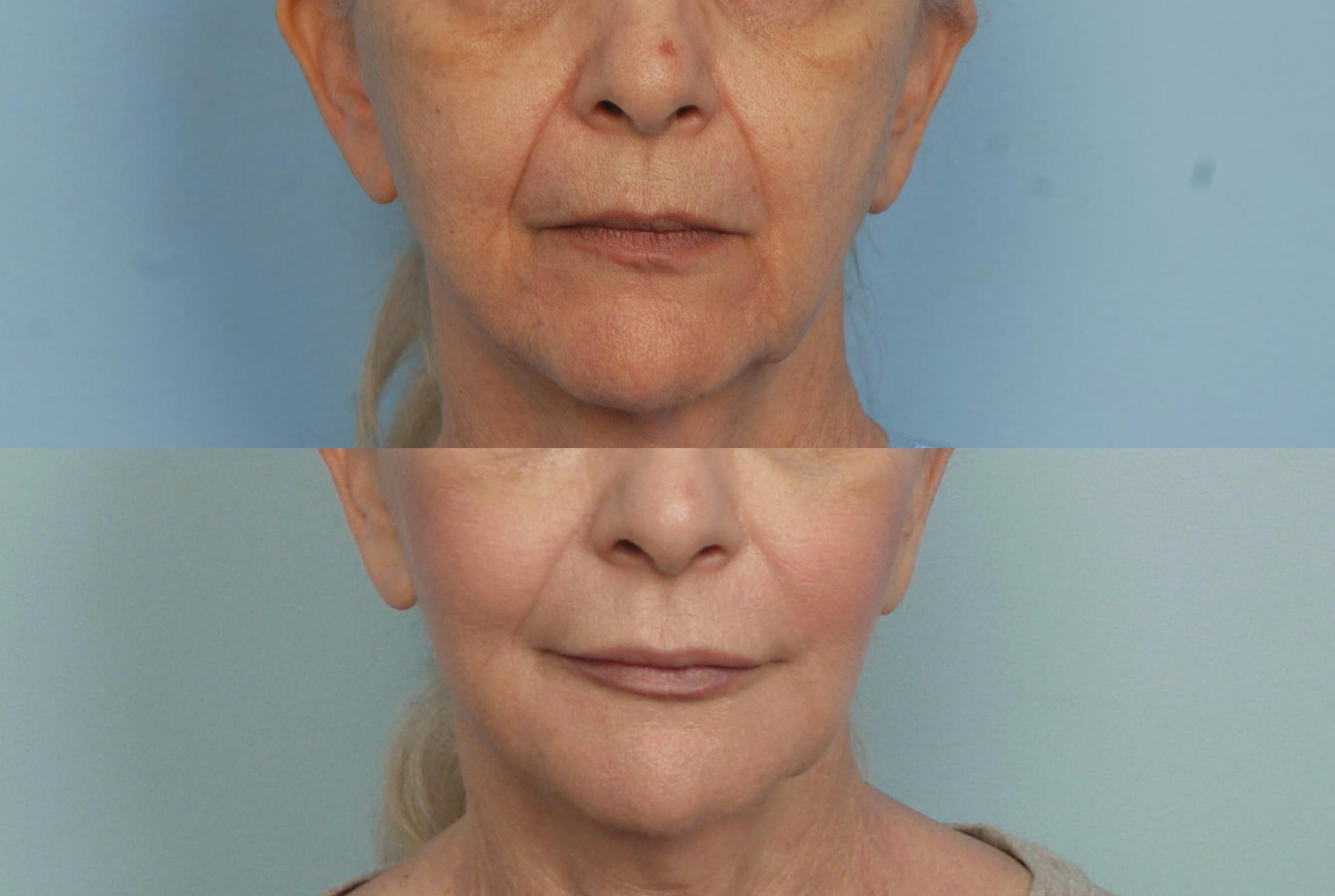 Fat Injections Before & After Gallery - Patient 48369864 - Image 1