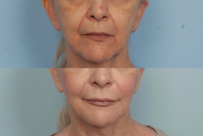 Lower Face Before & After Gallery - Patient 227069 - Image 1