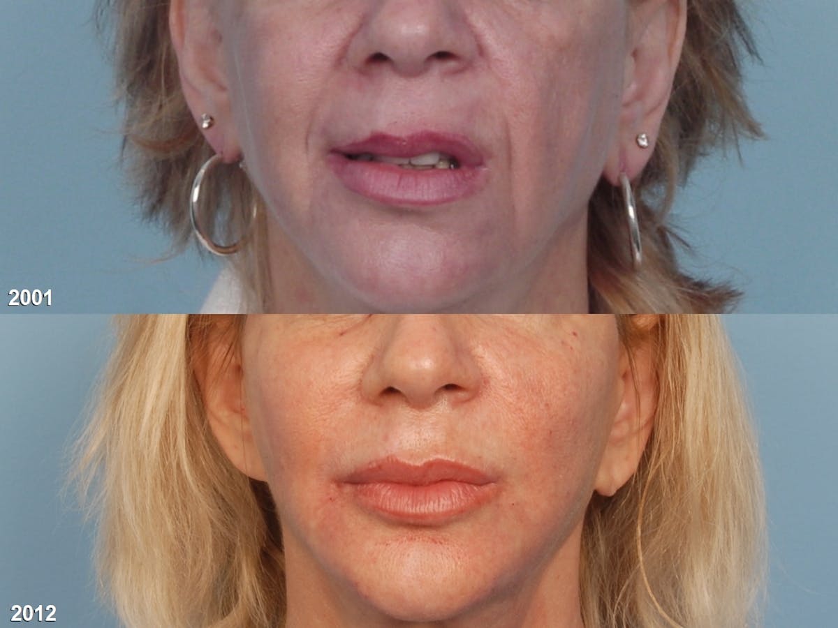 Lower Face Before & After Gallery - Patient 414137 - Image 3