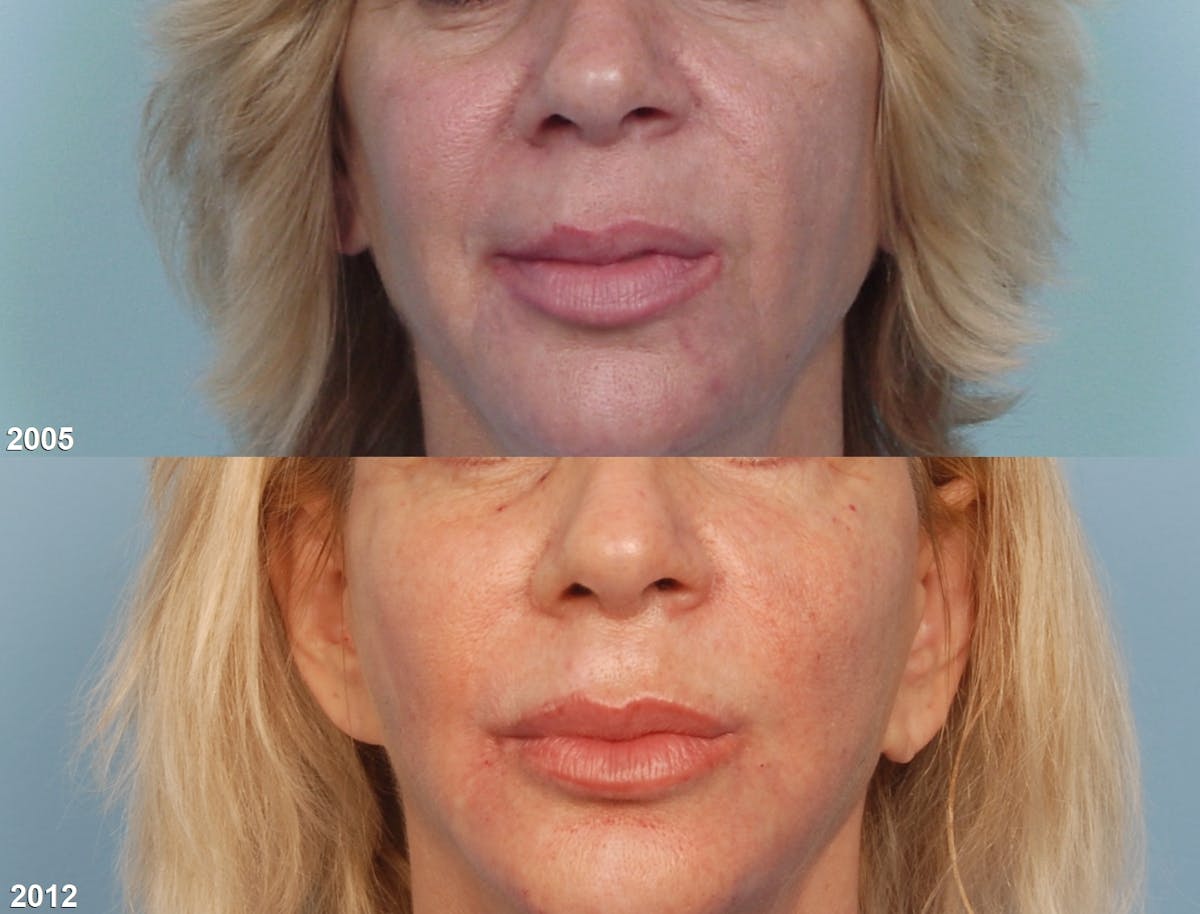 Lower Face Before & After Gallery - Patient 414137 - Image 2