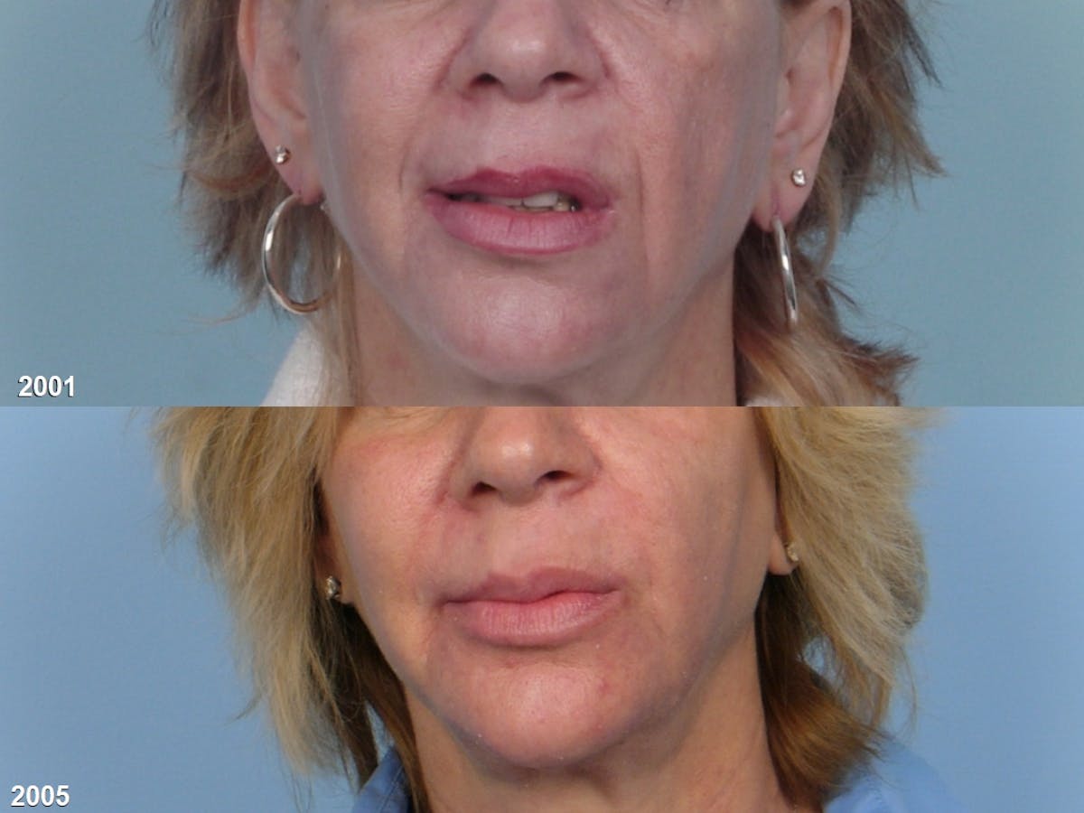 Lower Face Before & After Gallery - Patient 414137 - Image 1