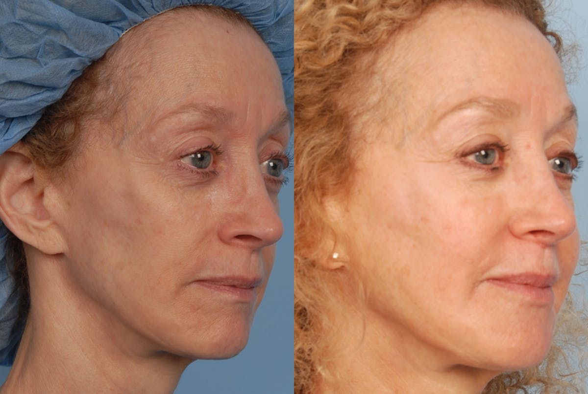 Full Face Before & After Gallery - Patient 204076 - Image 1