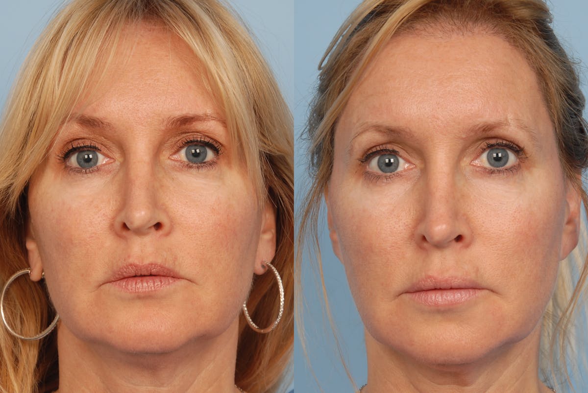 Lipotransfer Before & After Gallery - Patient 48369885 - Image 1