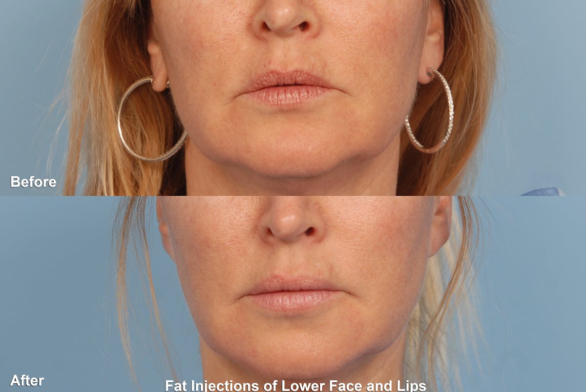 Lower Face Before & After Gallery - Patient 156702 - Image 1