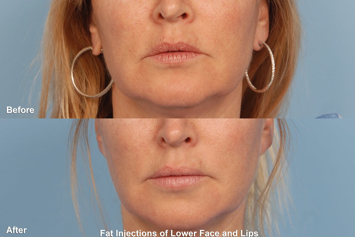 Fat Injections Before & After Gallery - Patient 48369888 - Image 1