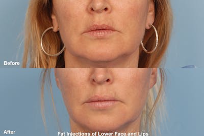 Lower Face Before & After Gallery - Patient 156702 - Image 1