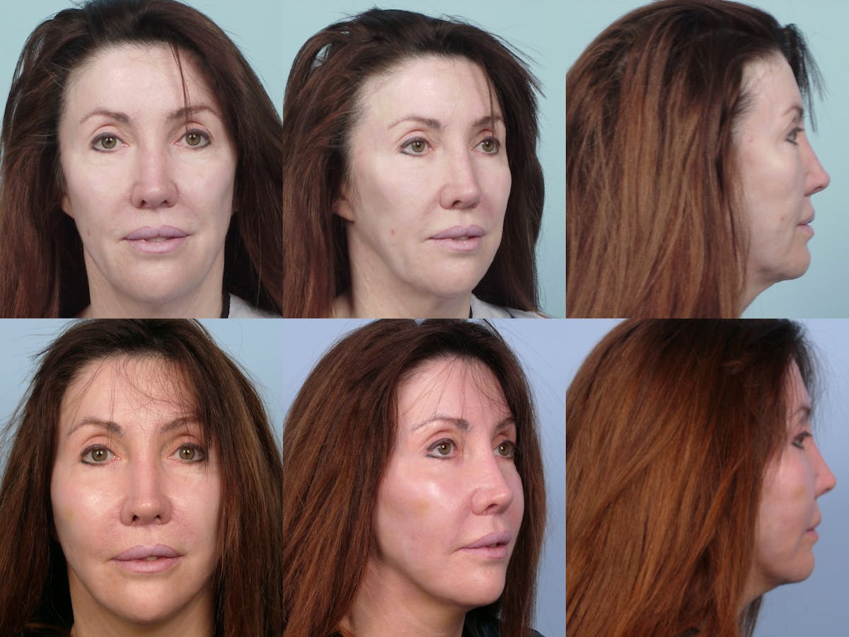 Full Face Before & After Gallery - Patient 154592 - Image 1