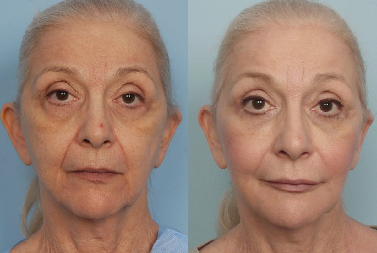 Lipotransfer Before & After Gallery - Patient 48369892 - Image 1