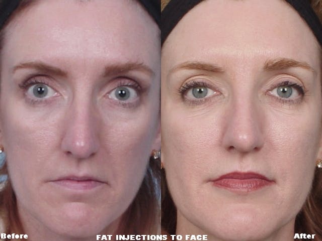 Fat Injections Before & After Gallery - Patient 48369900 - Image 1