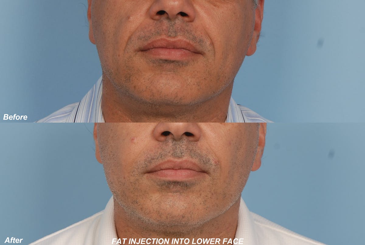 Fat Injections Before & After Gallery - Patient 48369901 - Image 1