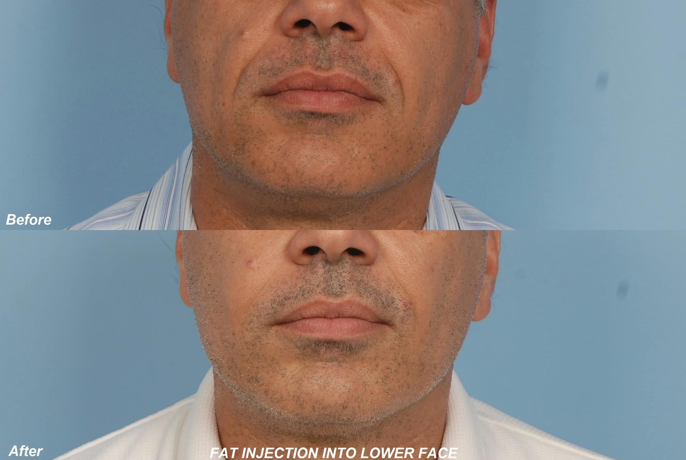 Fat Injections Before & After Gallery - Patient 48369901 - Image 1