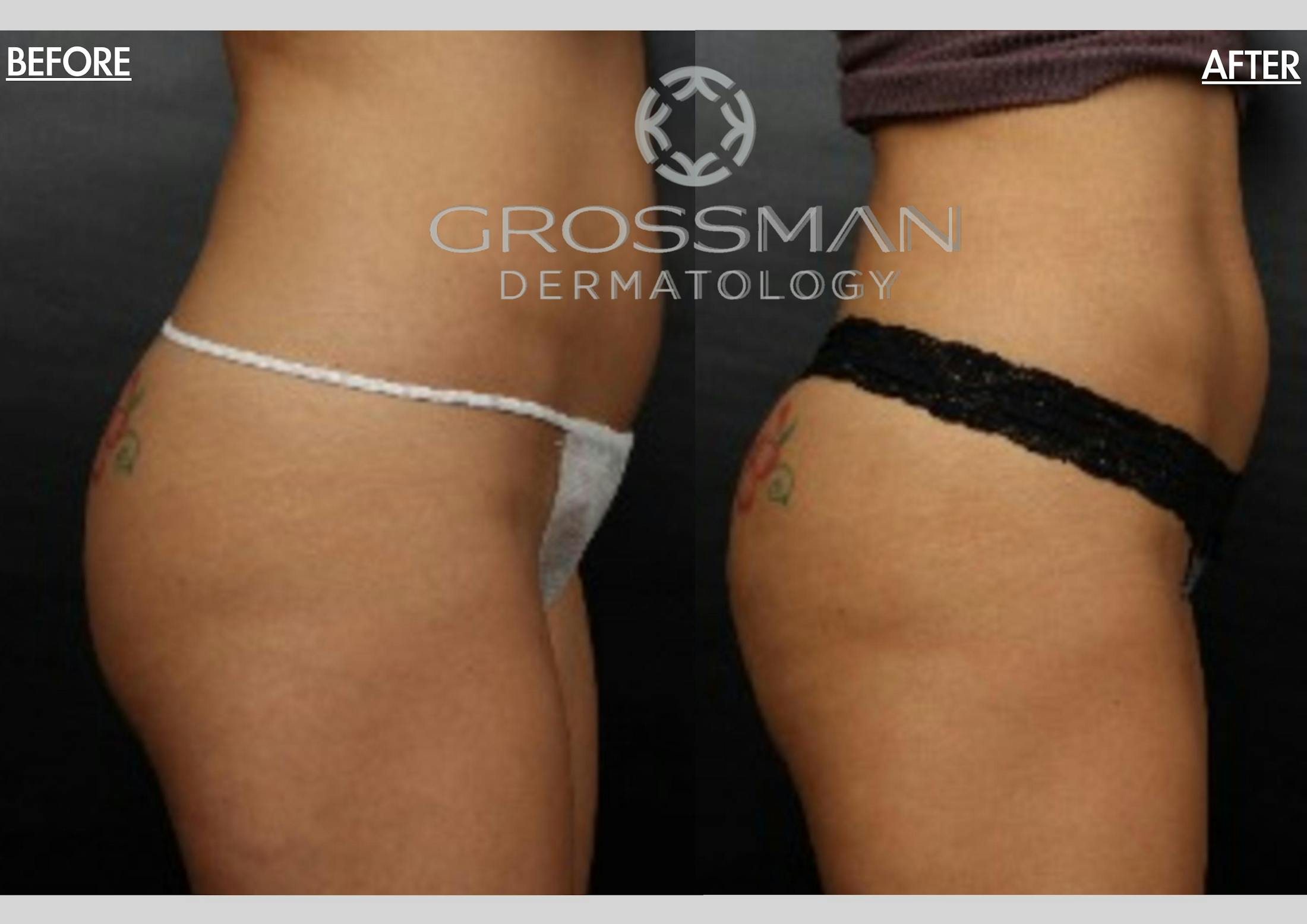 Sculptra Before & After Gallery - Patient 48370036 - Image 1
