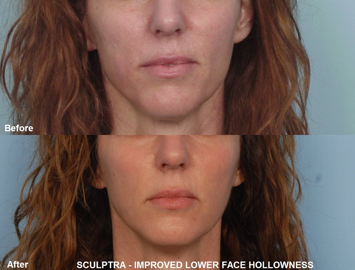 Sculptra Before & After Photos Grossman Dermatology