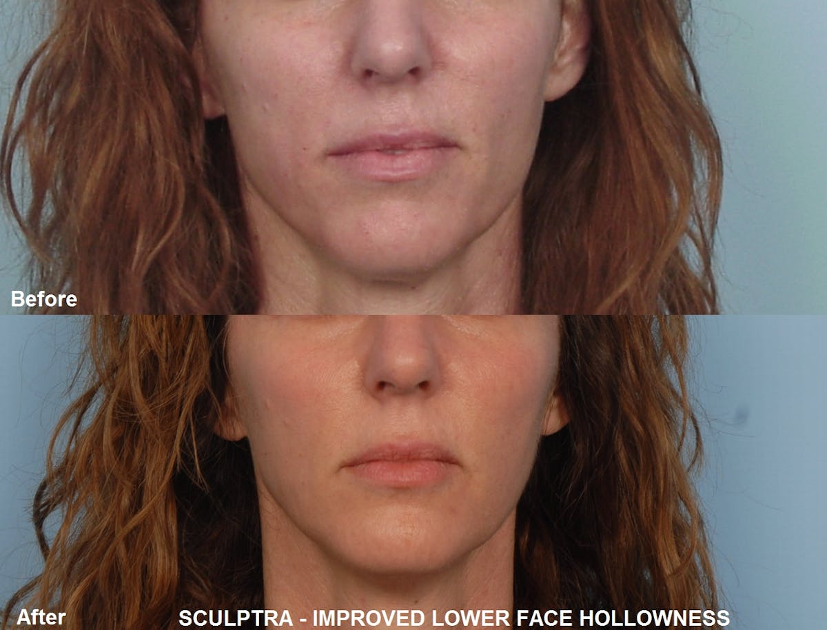 Sculptra Before & After Gallery - Patient 48370037 - Image 1