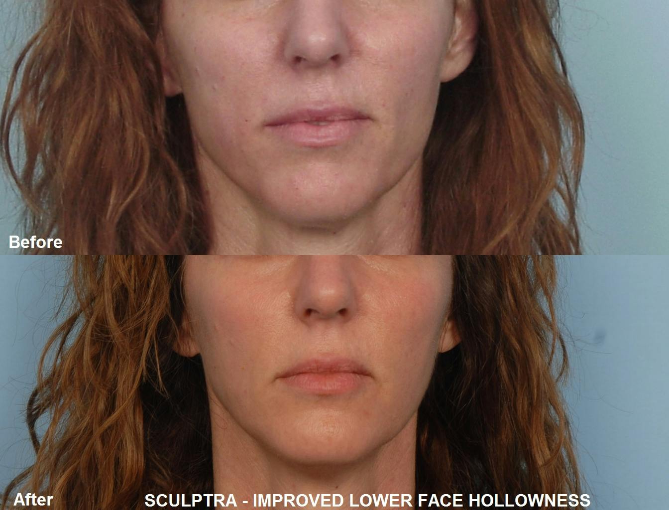Sculptra Before & After Gallery - Patient 48370037 - Image 1