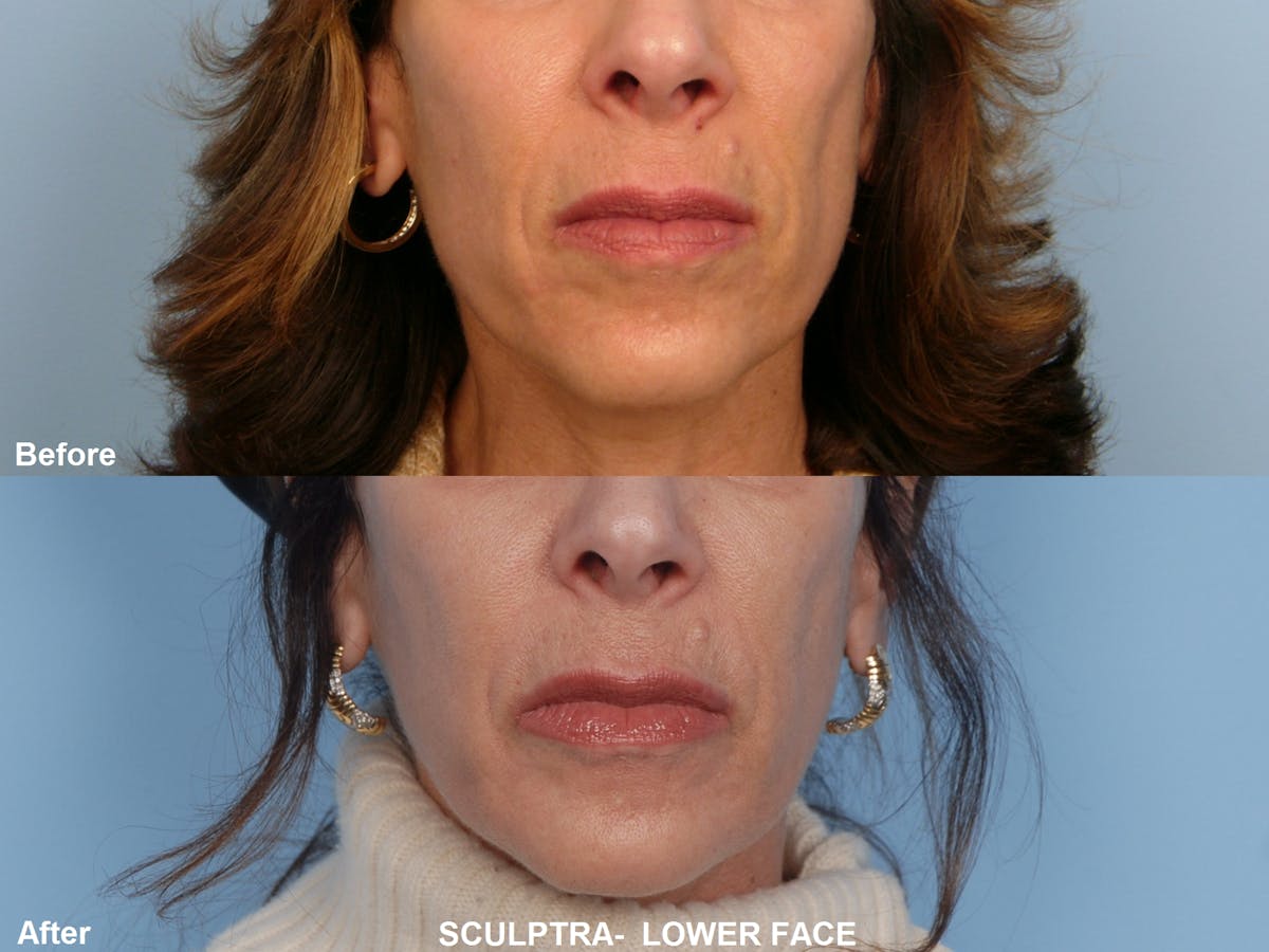 Sculptra Before & After Gallery - Patient 48370038 - Image 1