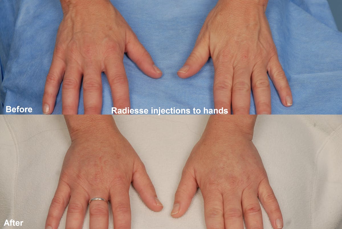 Crepey Skin Before & After Gallery - Patient 173972 - Image 1