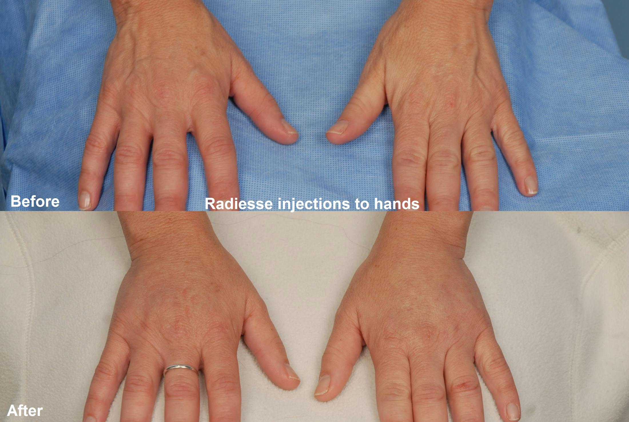 Fillers Before & After Gallery - Patient 173990348 - Image 1