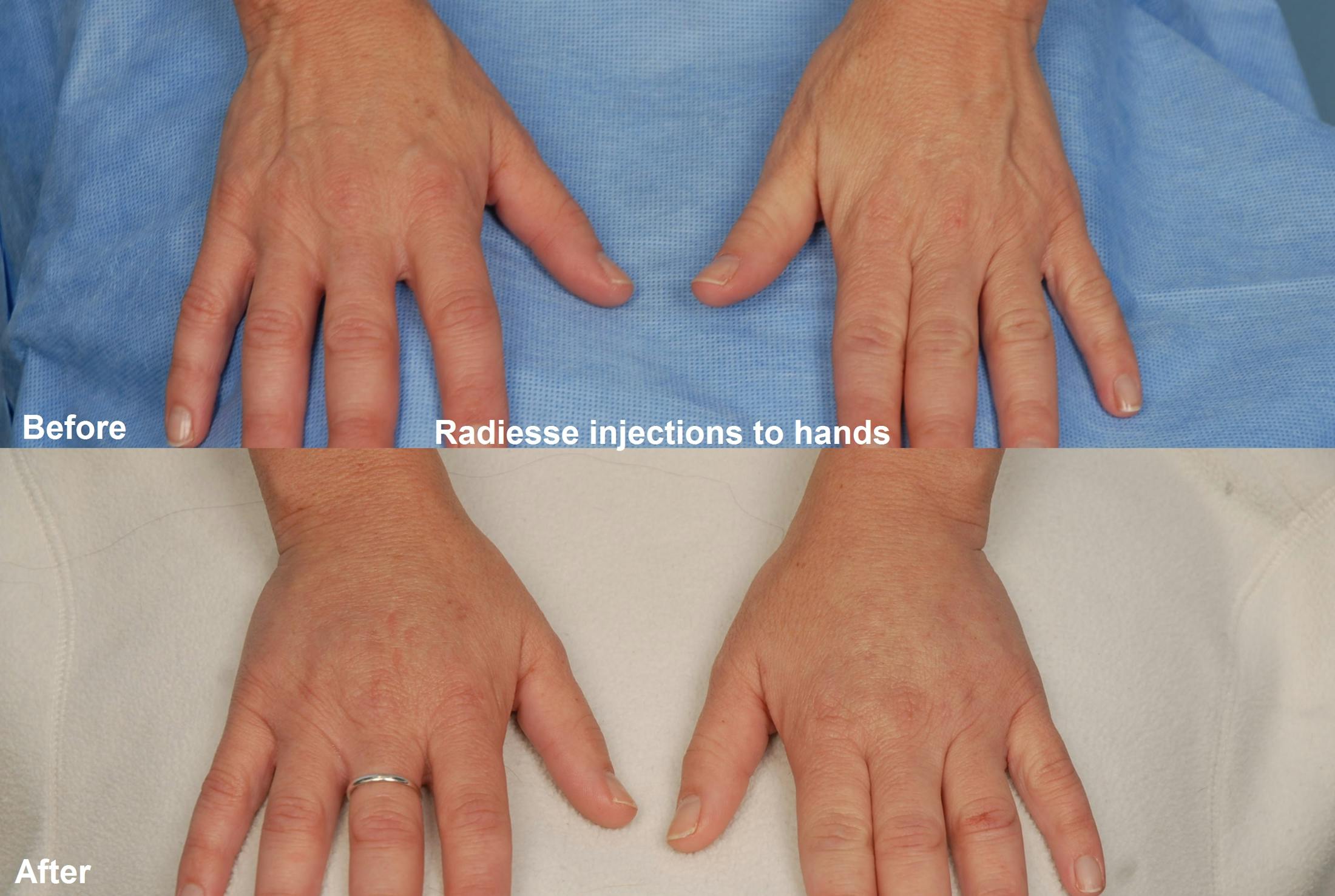 Radiesse Before & After Gallery - Patient 48370063 - Image 1