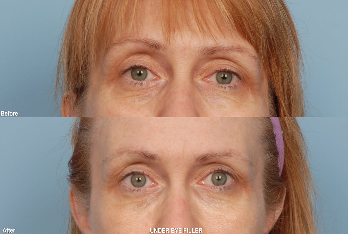 Eyes Before & After Gallery - Patient 917285 - Image 1