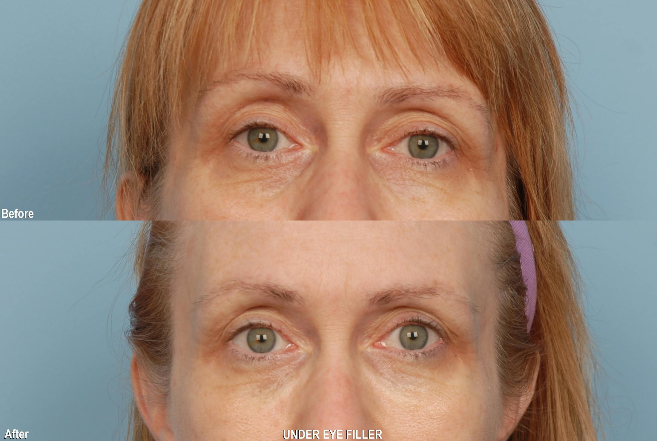 Fillers Before & After Gallery - Patient 173995268 - Image 1