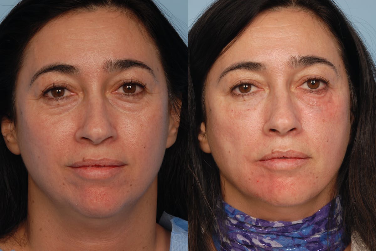 Lower Face Before & After Gallery - Patient 275315 - Image 1