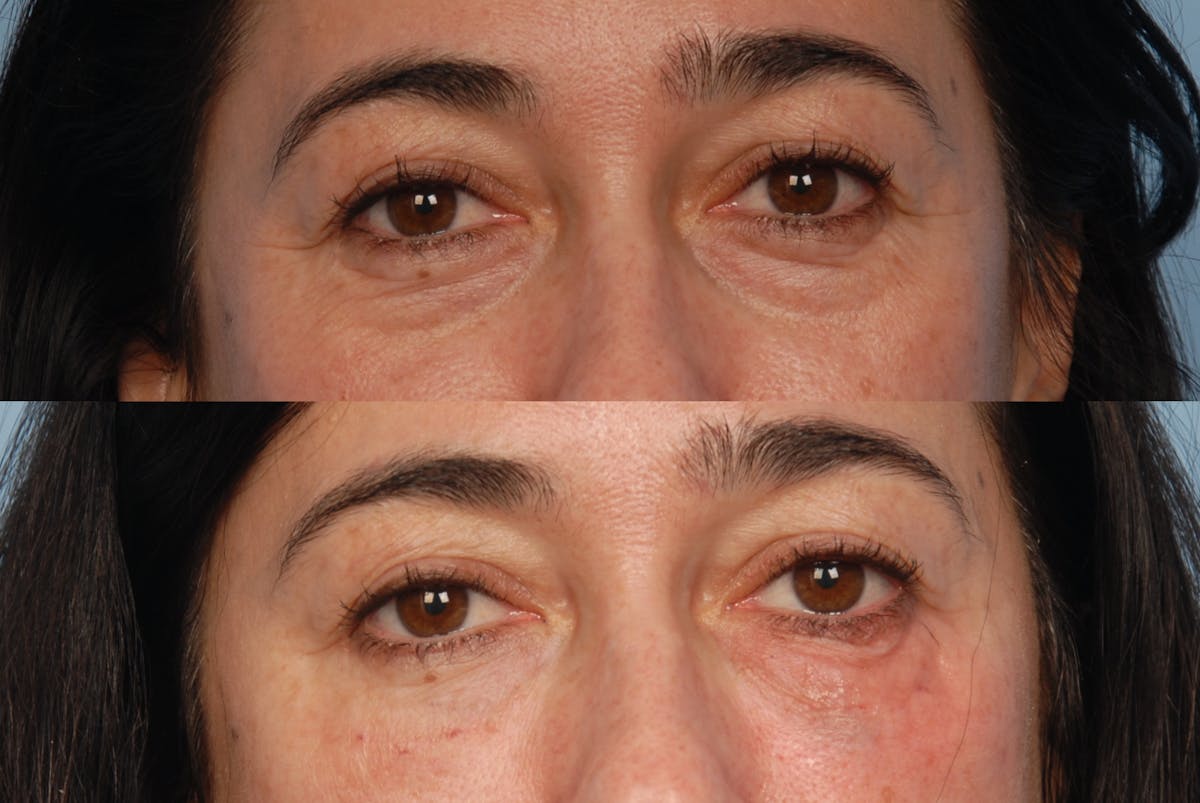 Lower Face Before & After Gallery - Patient 275315 - Image 2