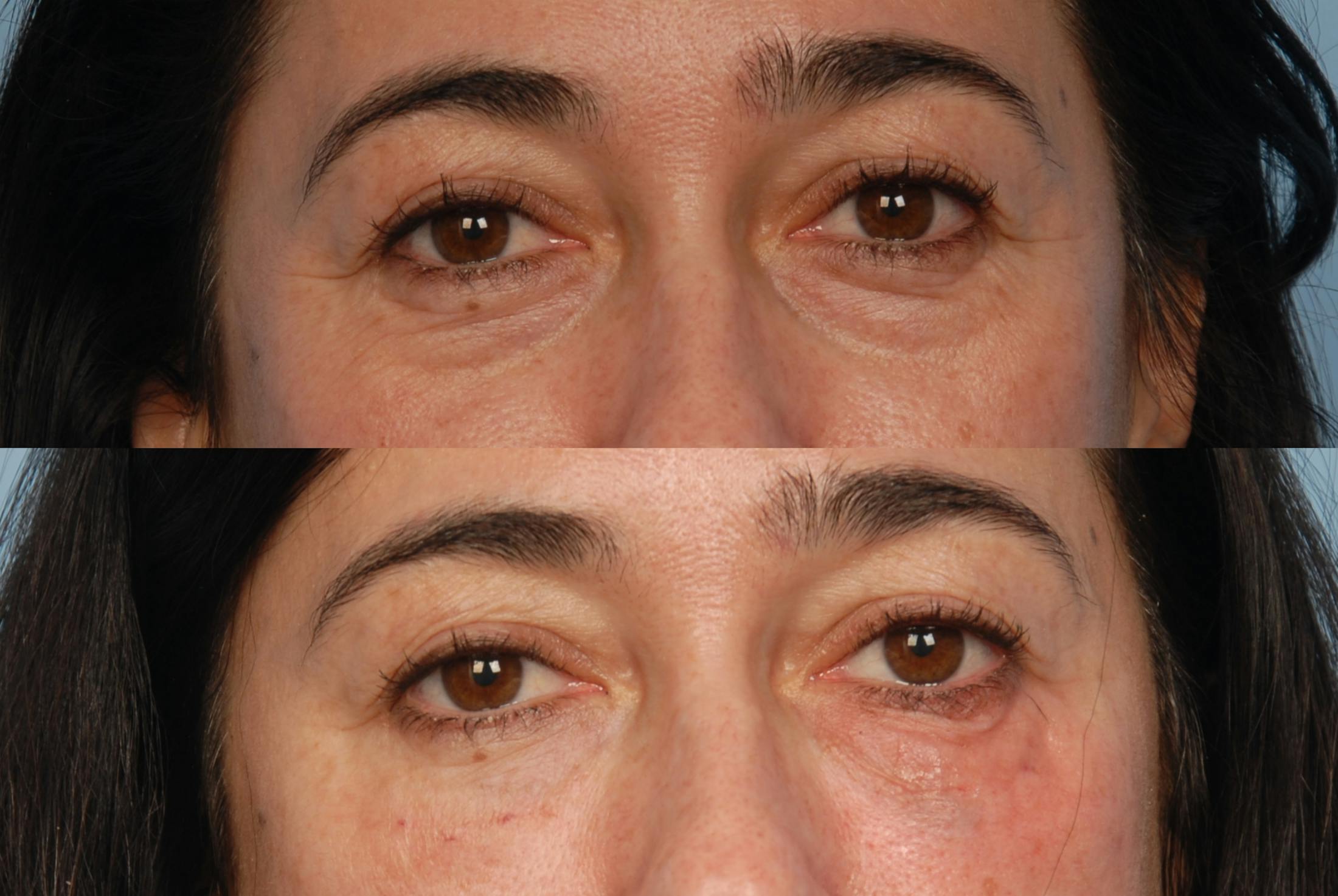 Under Eye Filler Before & After Gallery - Patient 48370077 - Image 2
