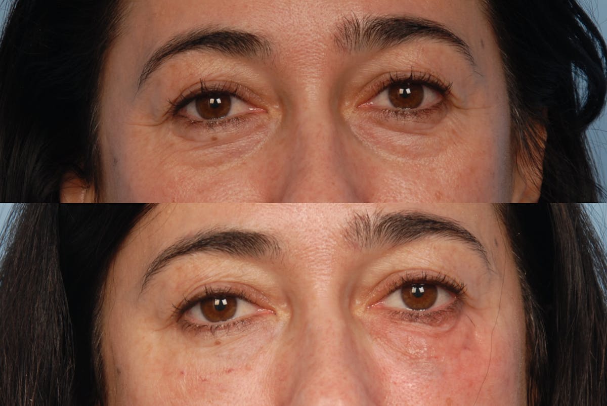 Fillers Before & After Gallery - Patient 173995269 - Image 2