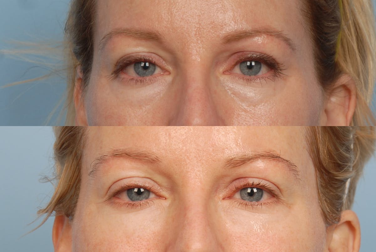 Eyes Before & After Gallery - Patient 101613 - Image 1