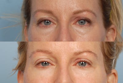 Eyes Before & After Gallery - Patient 101613 - Image 1