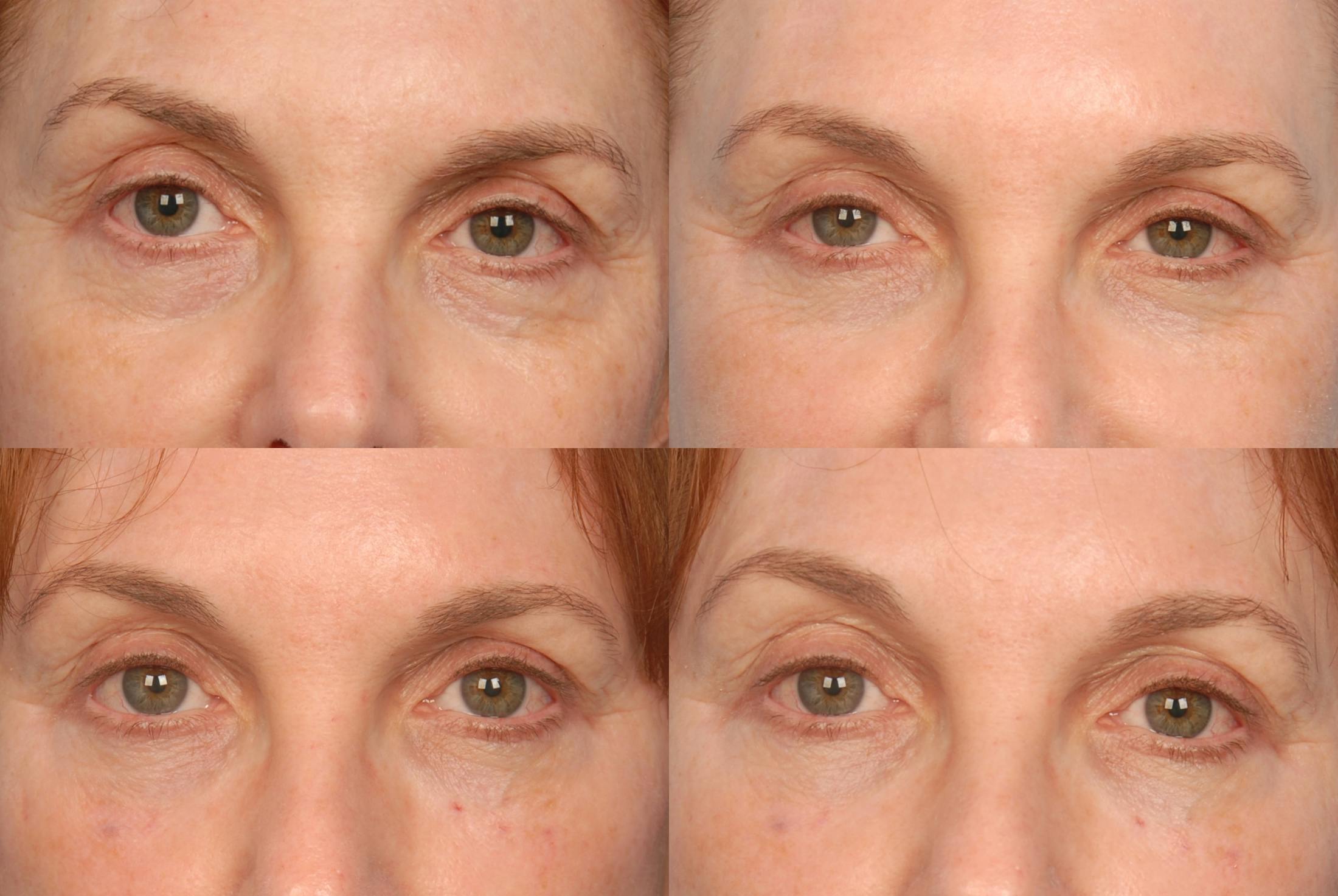 Under Eye Filler Before & After Gallery - Patient 48370079 - Image 1