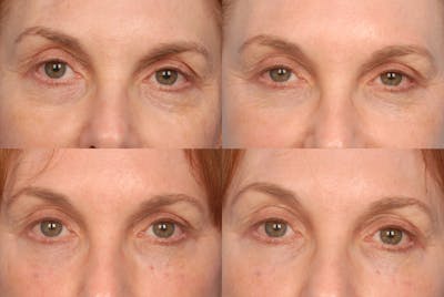 Eyes Before & After Gallery - Patient 275738 - Image 1