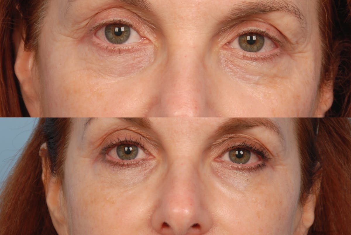 Eyes Before & After Gallery - Patient 232518 - Image 1