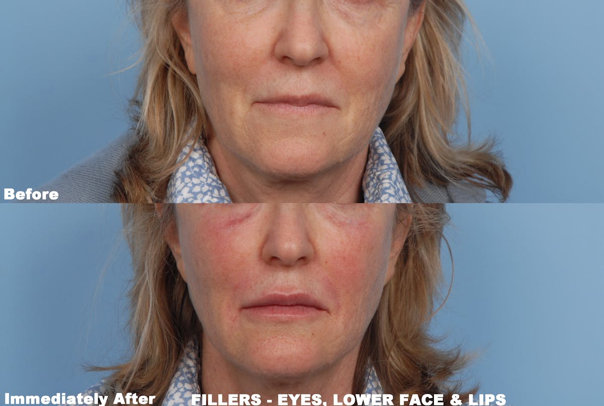 Lower Face Before & After Gallery - Patient 646368 - Image 1