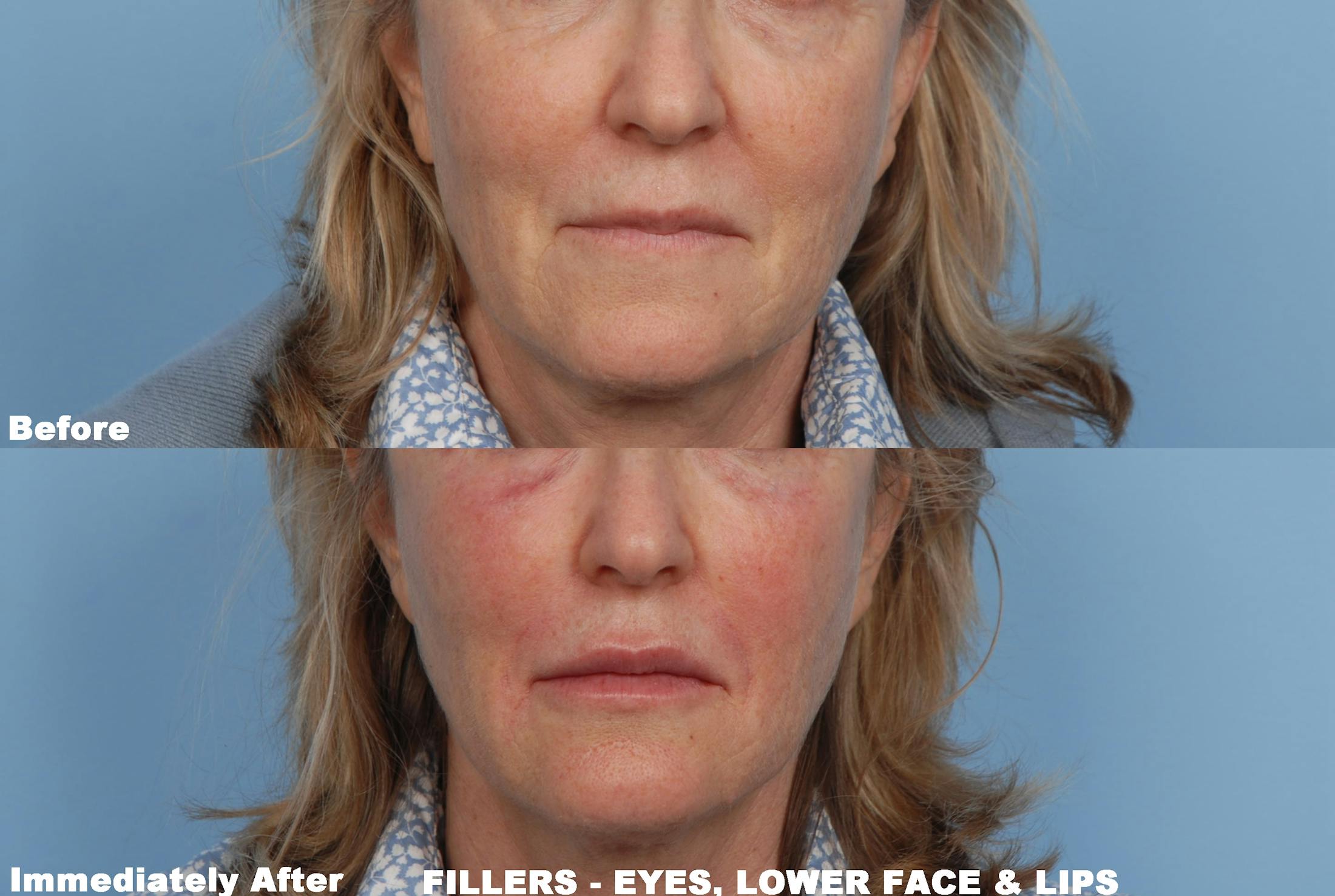 Lower Face Filler Before & After Gallery - Patient 48370088 - Image 1