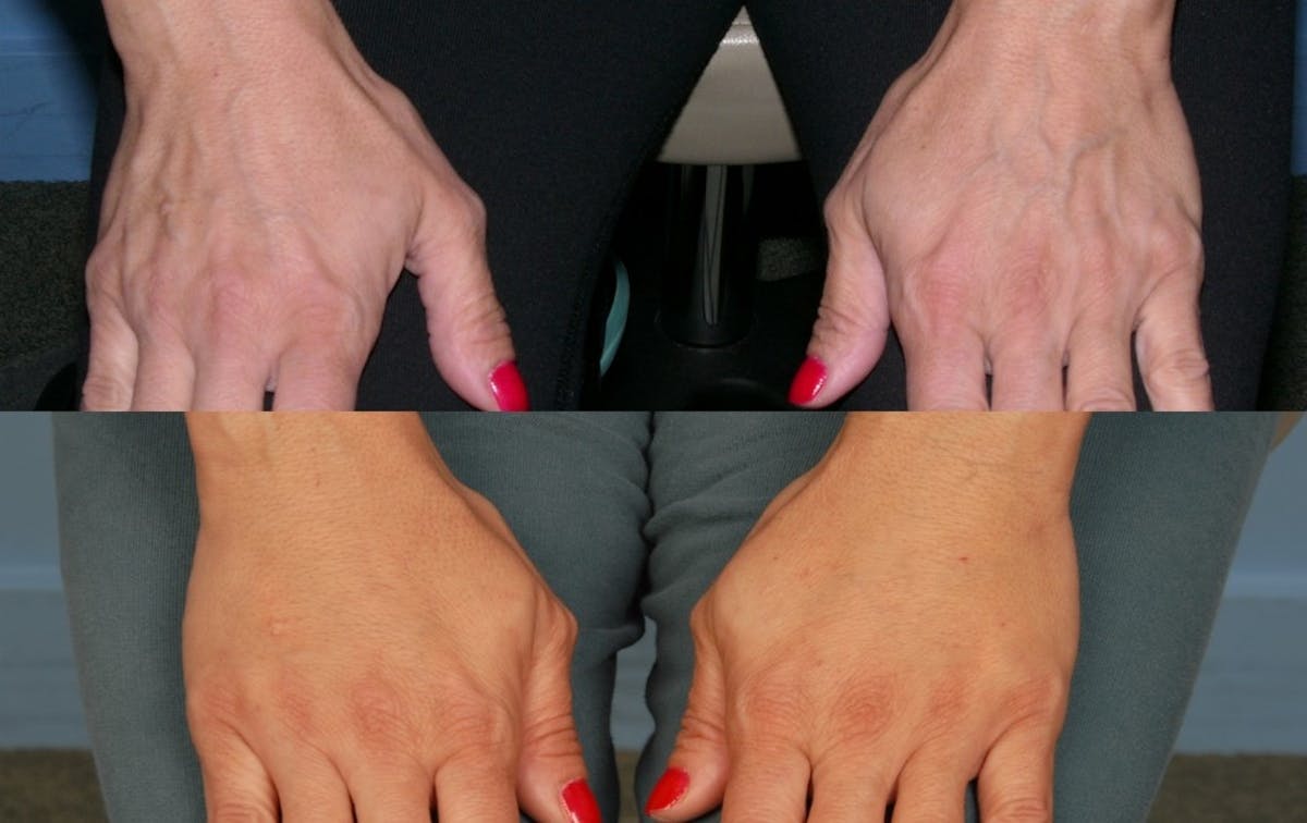 Crepey Skin Before & After Gallery - Patient 146916 - Image 1